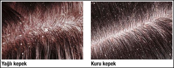 Kepek nasıl oluşur? Kepek nasıl oluşur?